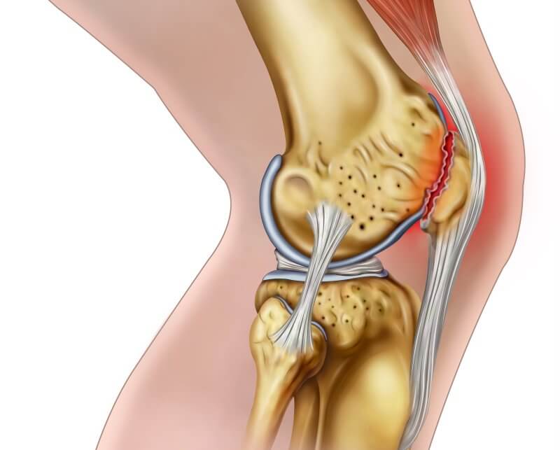 Chondromalacia patella iskorak